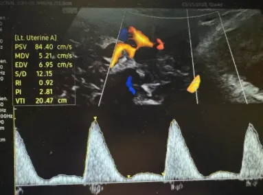 Posts | Uterine Artery Doppler First Trimester Pre-Eclampsia Screening ...