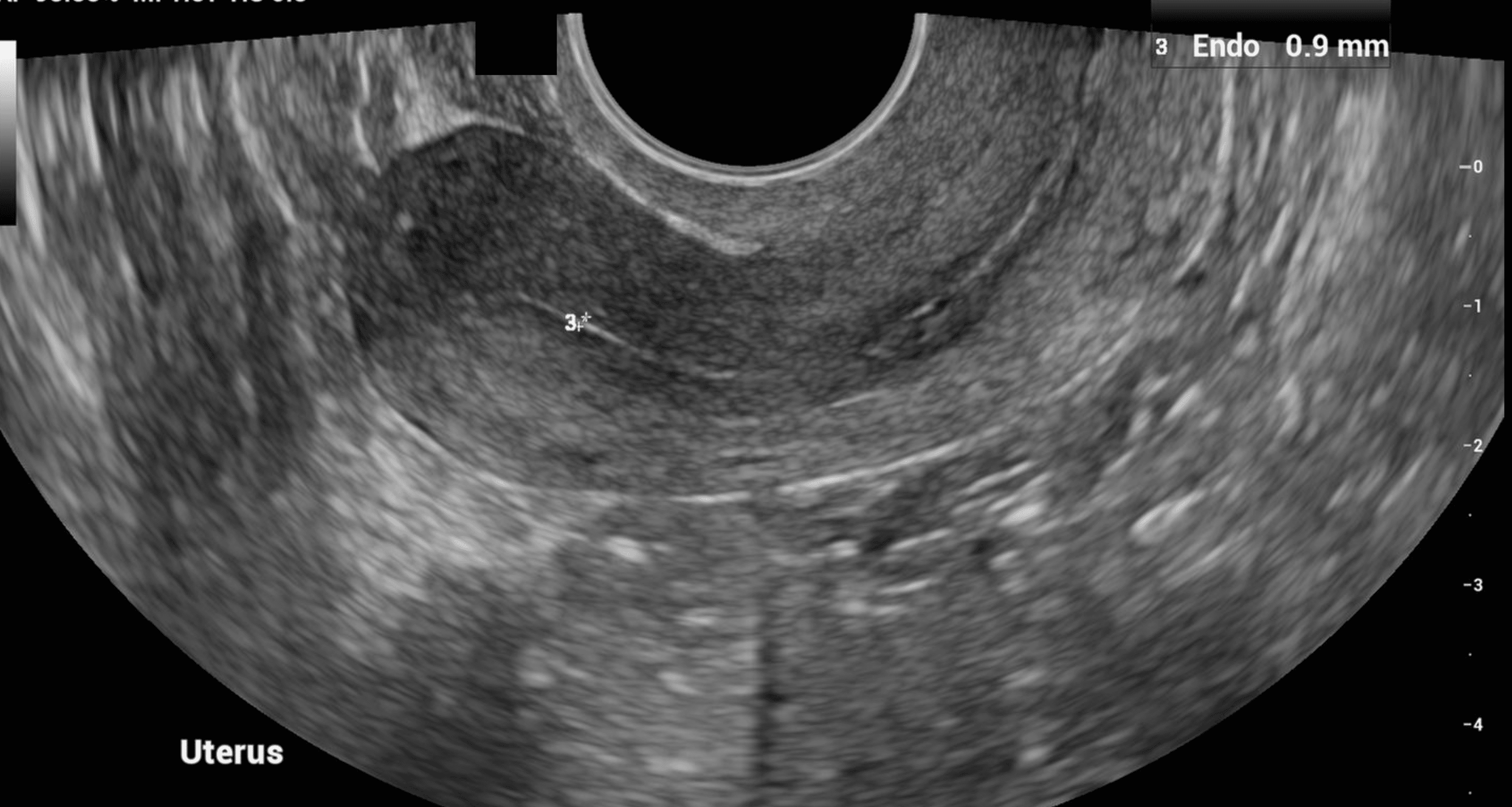 Rozrost Endometrium Z Atypią Leczenie The Endometrium - Final Quiz